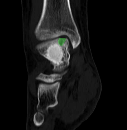 CT Scan Defect