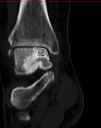 Implant Sizing on CT Scan