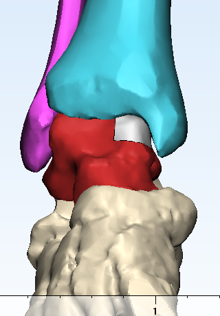 Computer Rendering Final Talar Implant Placement