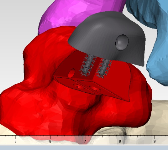 Computer Rendering of the Custom Implant Technique