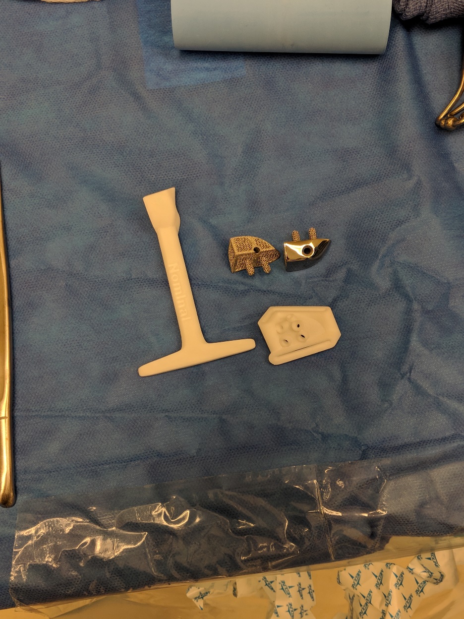 Actual Custom Implant and Cutting Guides