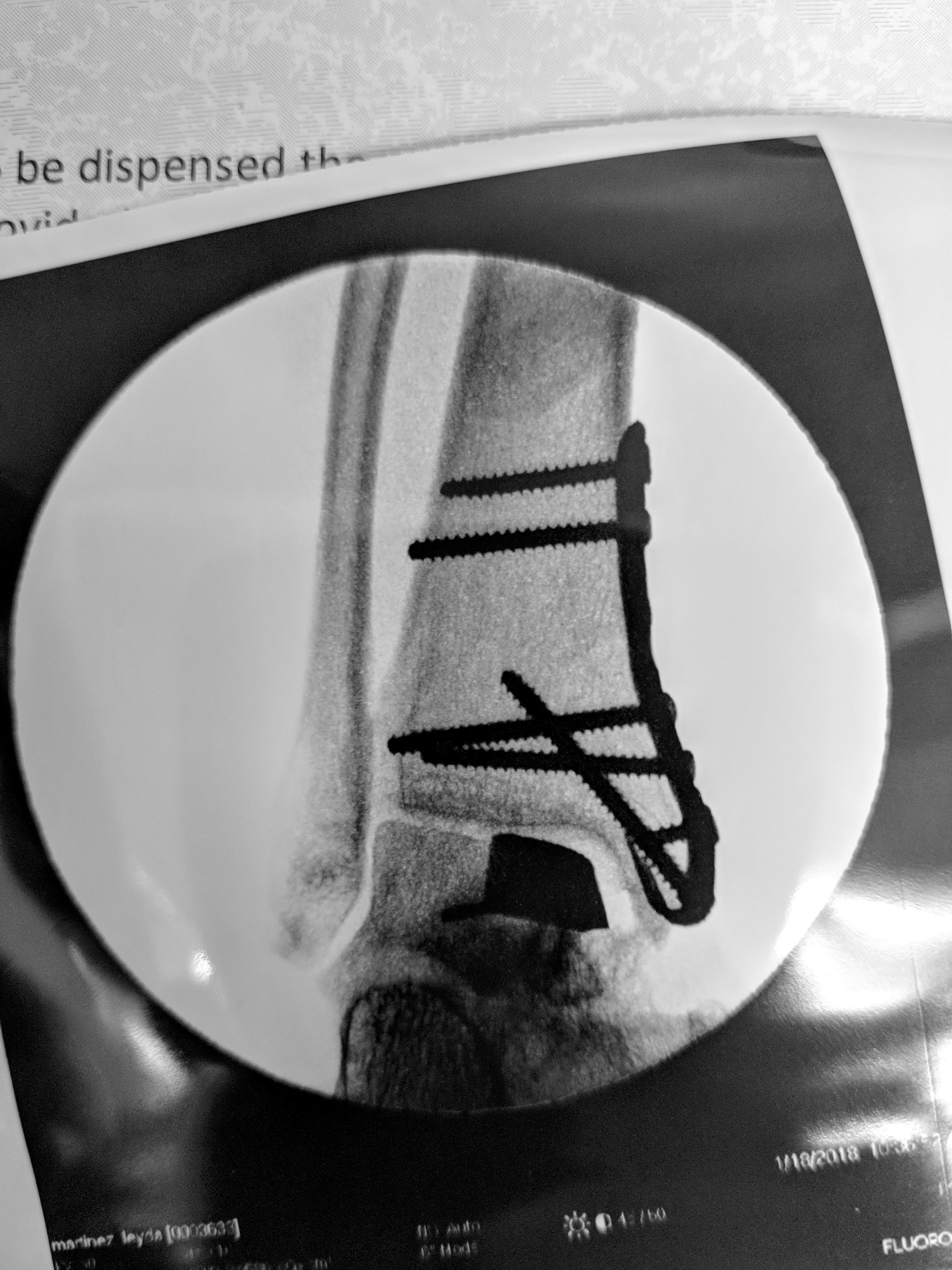 Actual Pictures from Surgery Showing Final Implant