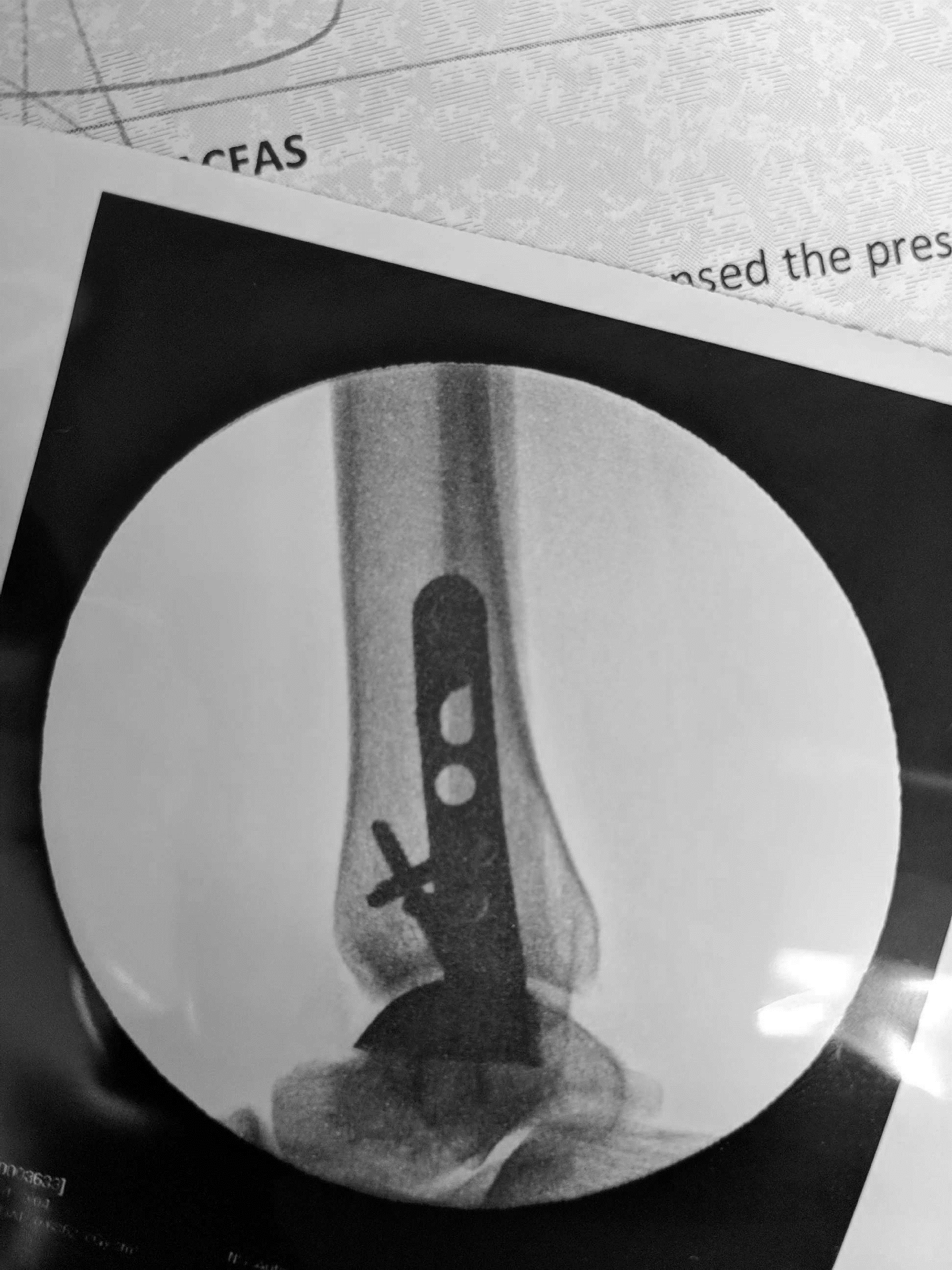 Actual Pictures from Surgery Showing Final Implant